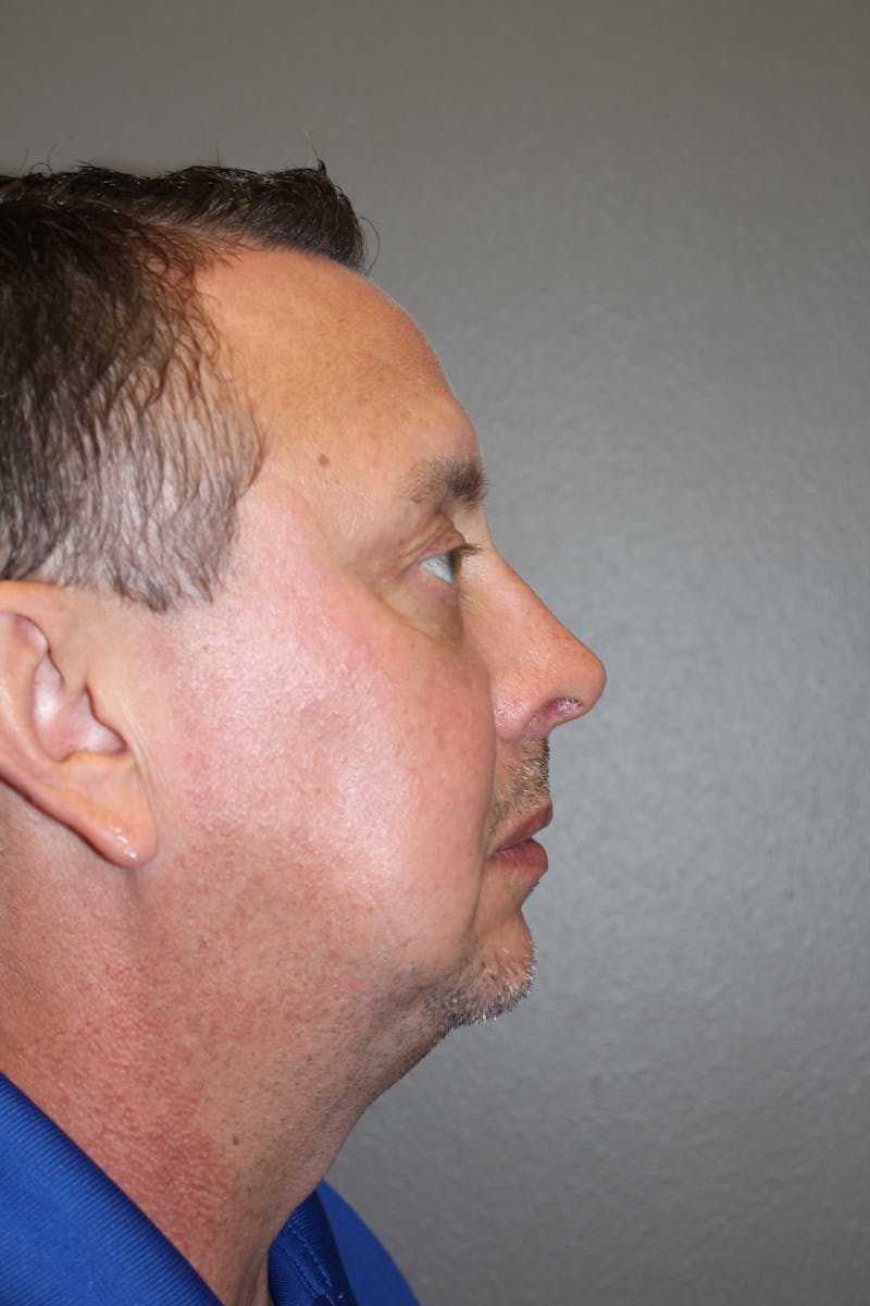 Rhinoplasty Before & After Gallery - Patient 218367 - Image 2