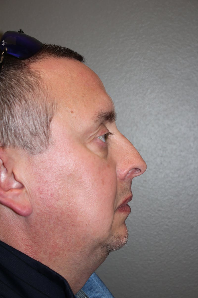 Rhinoplasty Before & After Gallery - Patient 218367 - Image 1