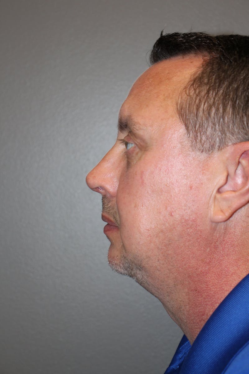 Rhinoplasty Before & After Gallery - Patient 218367 - Image 10