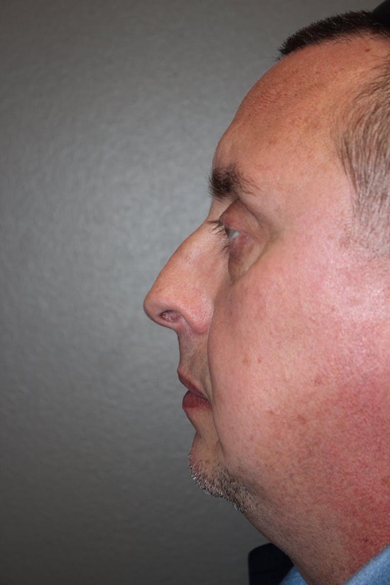 Rhinoplasty Before & After Gallery - Patient 218367 - Image 9