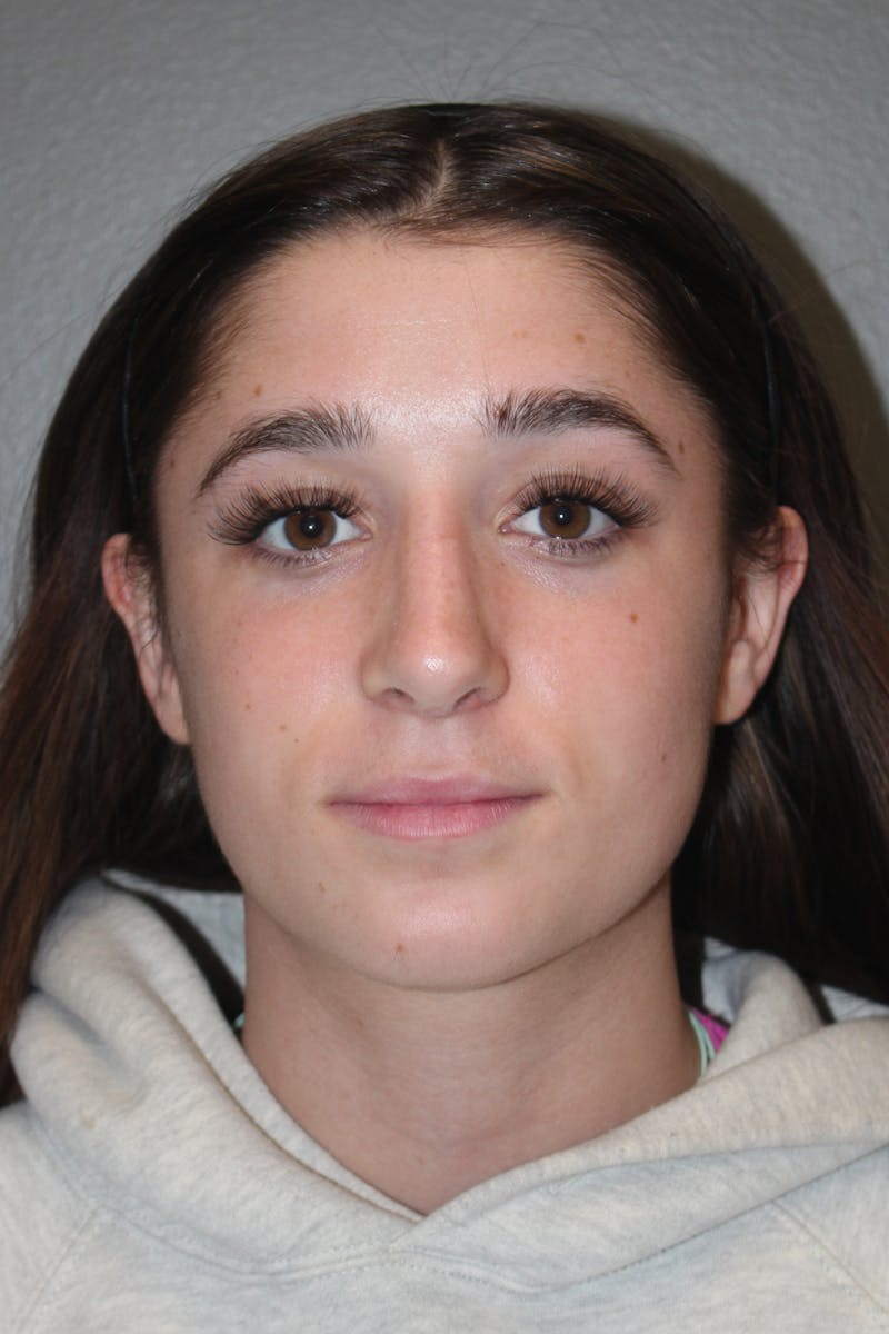 Rhinoplasty Before & After Gallery - Patient 133596 - Image 6
