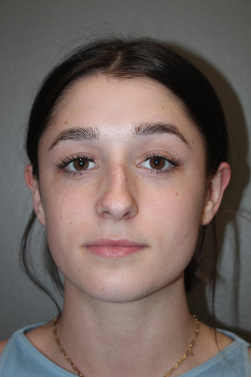 Rhinoplasty Before & After Gallery - Patient 133596 - Image 5