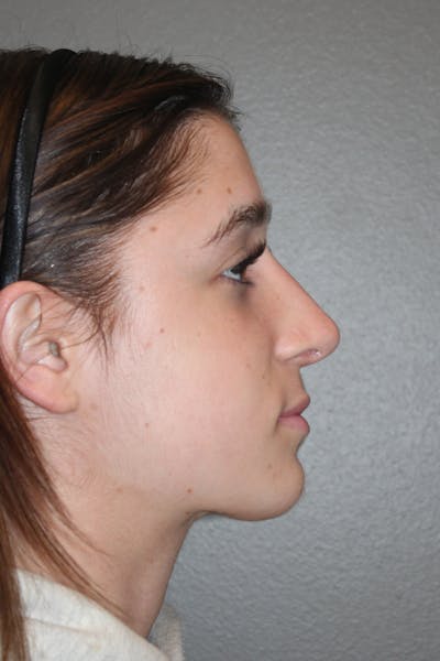 Rhinoplasty Before & After Gallery - Patient 133596 - Image 2