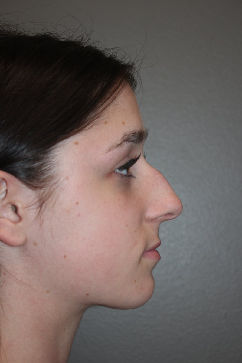 Rhinoplasty Before & After Gallery - Patient 133596 - Image 1