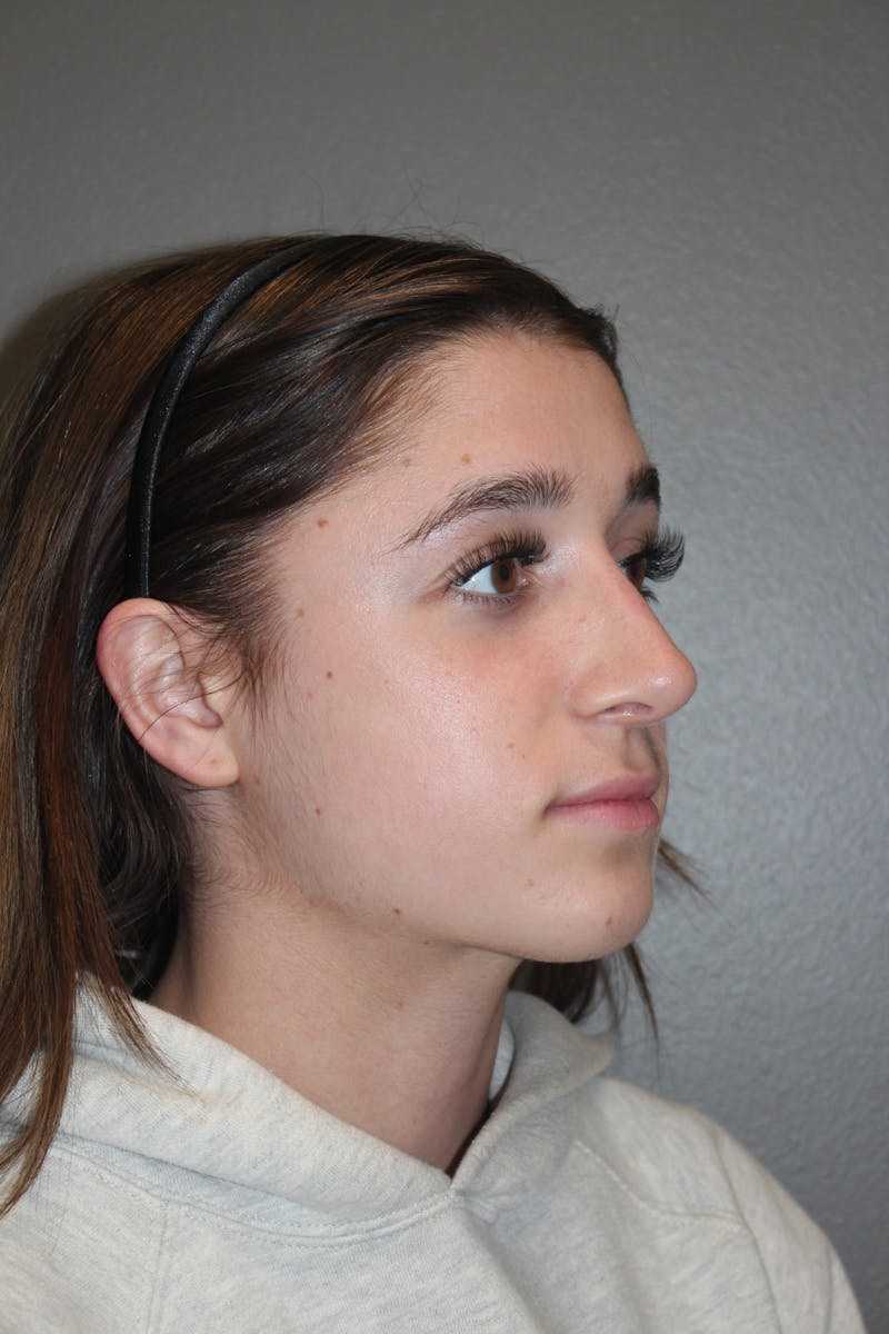 Rhinoplasty Before & After Gallery - Patient 133596 - Image 4
