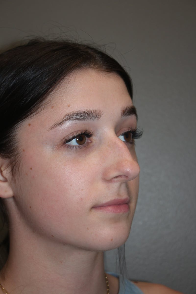 Rhinoplasty Before & After Gallery - Patient 133596 - Image 3