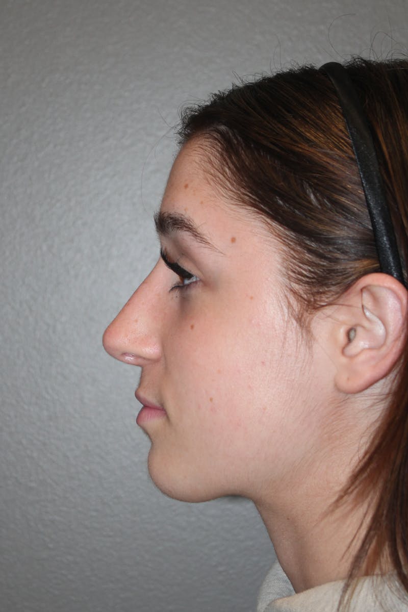 Rhinoplasty Before & After Gallery - Patient 133596 - Image 10