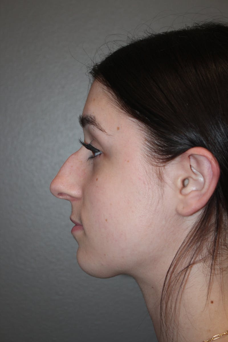 Rhinoplasty Before & After Gallery - Patient 133596 - Image 9