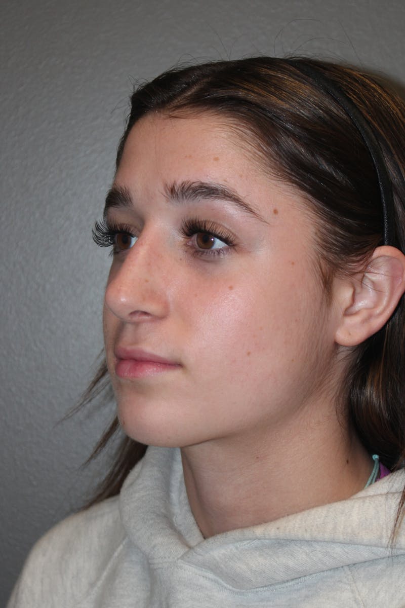 Rhinoplasty Before & After Gallery - Patient 133596 - Image 8
