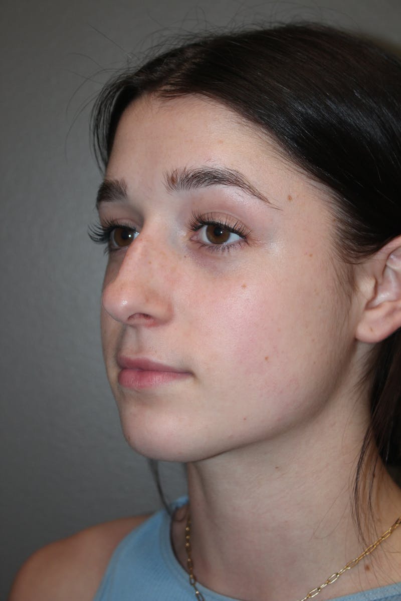 Rhinoplasty Before & After Gallery - Patient 133596 - Image 7