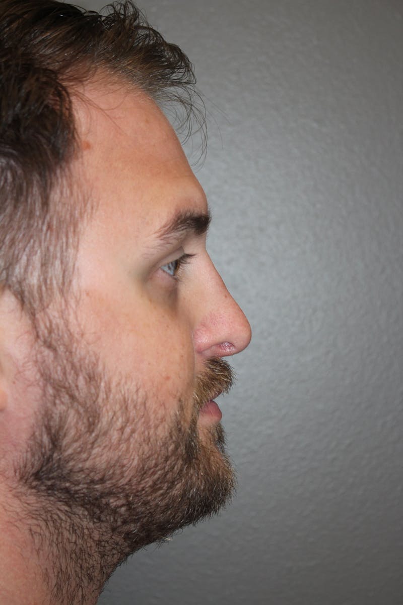 Rhinoplasty Before & After Gallery - Patient 572902 - Image 2