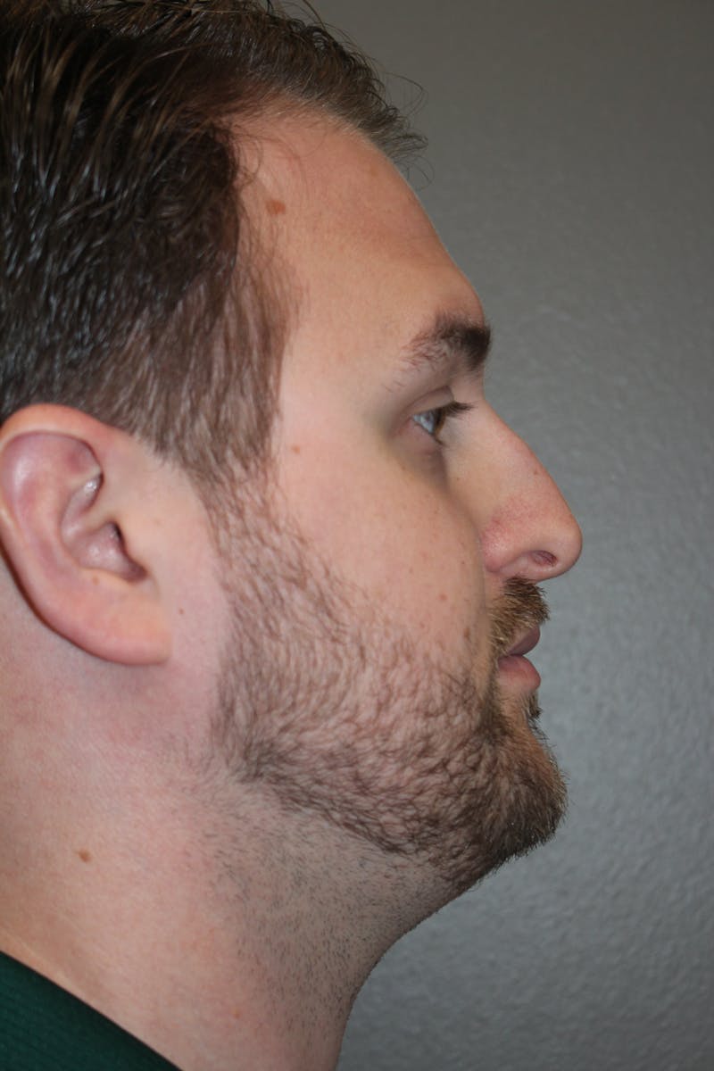 Rhinoplasty Before & After Gallery - Patient 572902 - Image 1