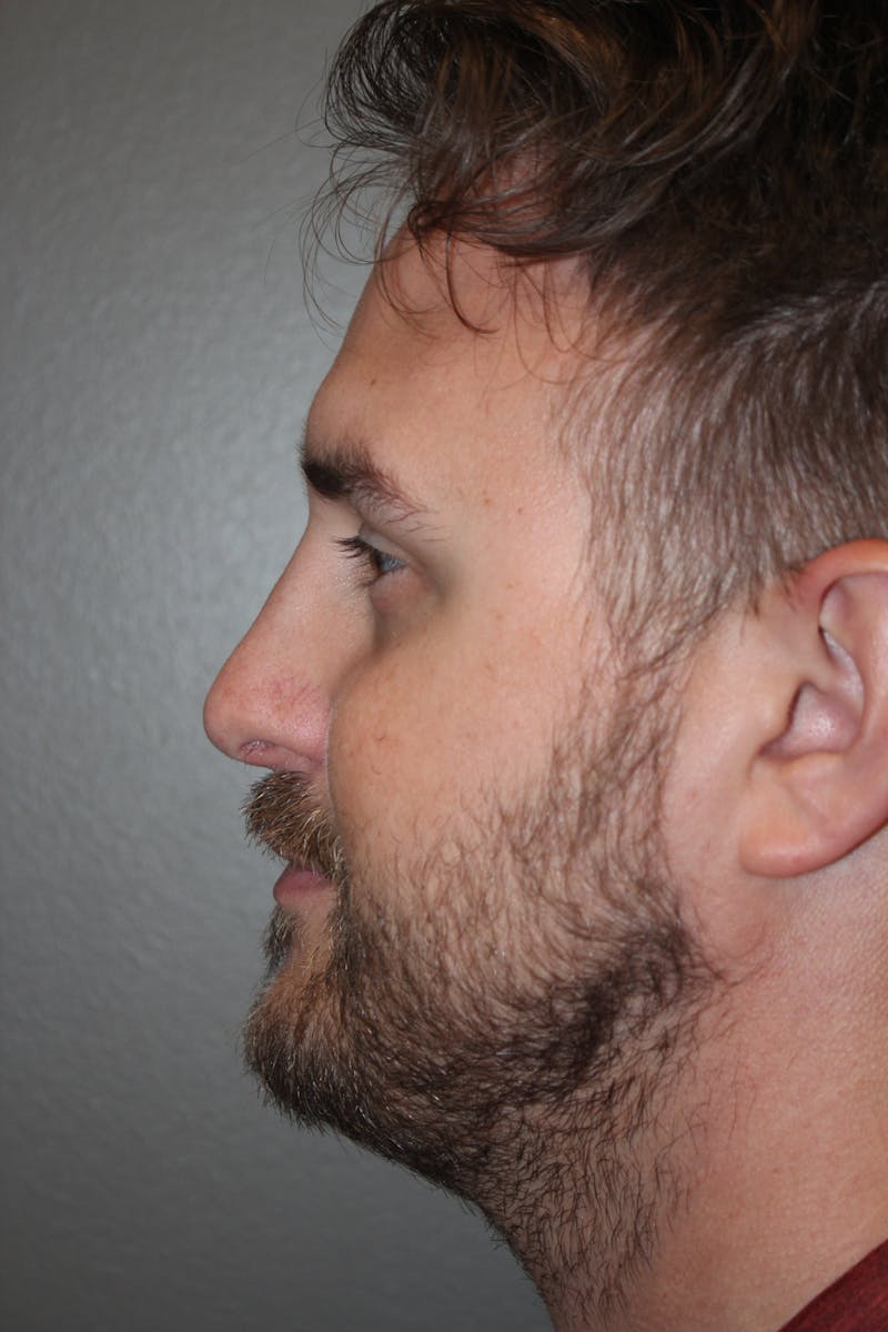 Rhinoplasty Before & After Gallery - Patient 572902 - Image 10