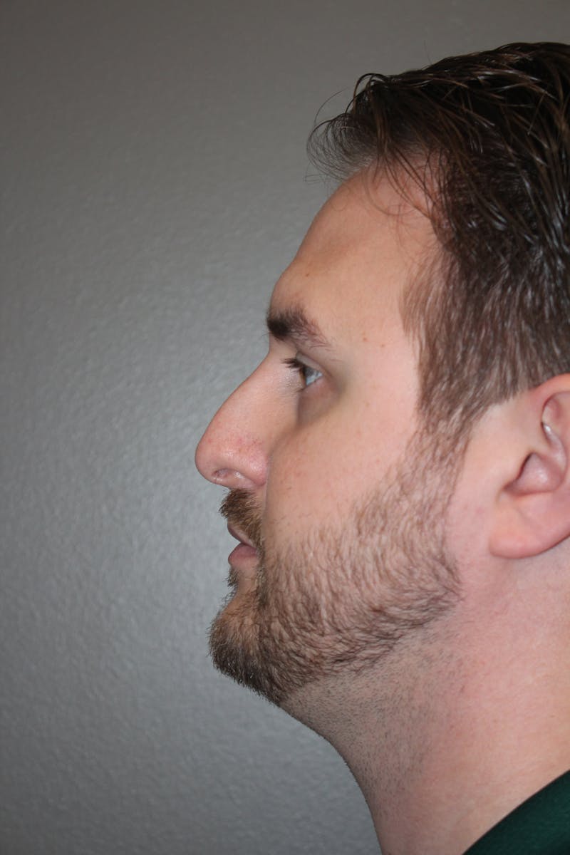 Rhinoplasty Before & After Gallery - Patient 572902 - Image 9