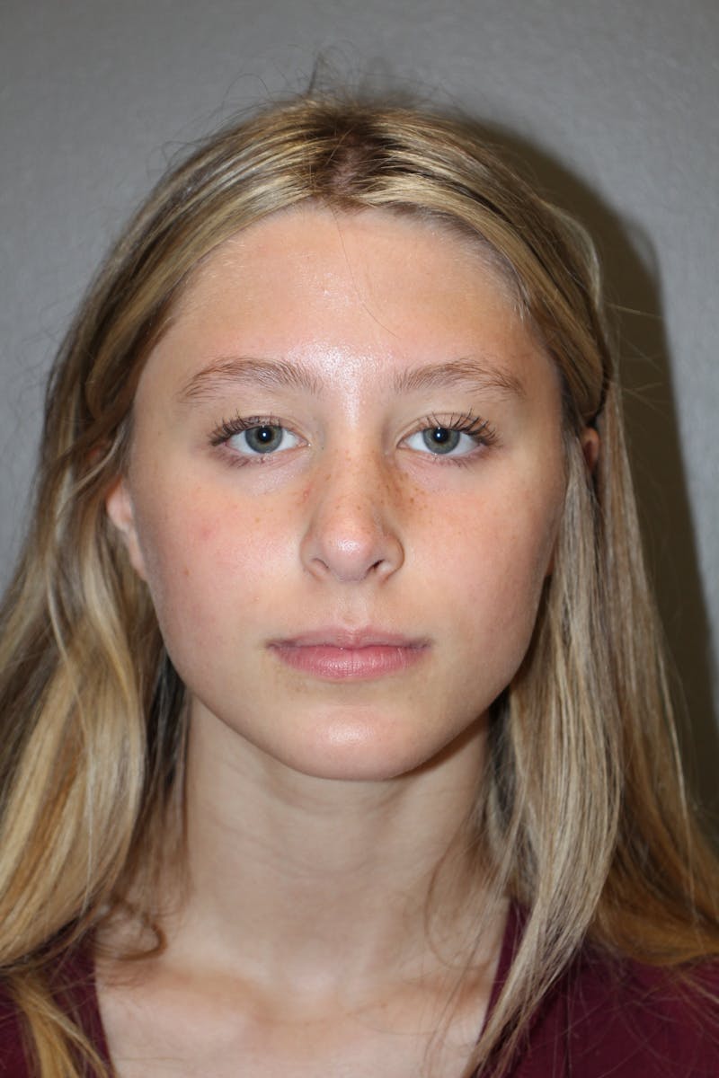 Rhinoplasty Before & After Gallery - Patient 415553 - Image 6
