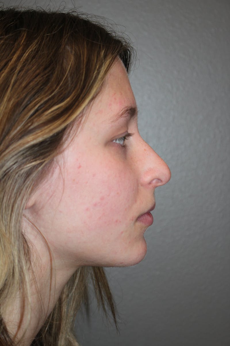 Rhinoplasty Before & After Gallery - Patient 415553 - Image 1