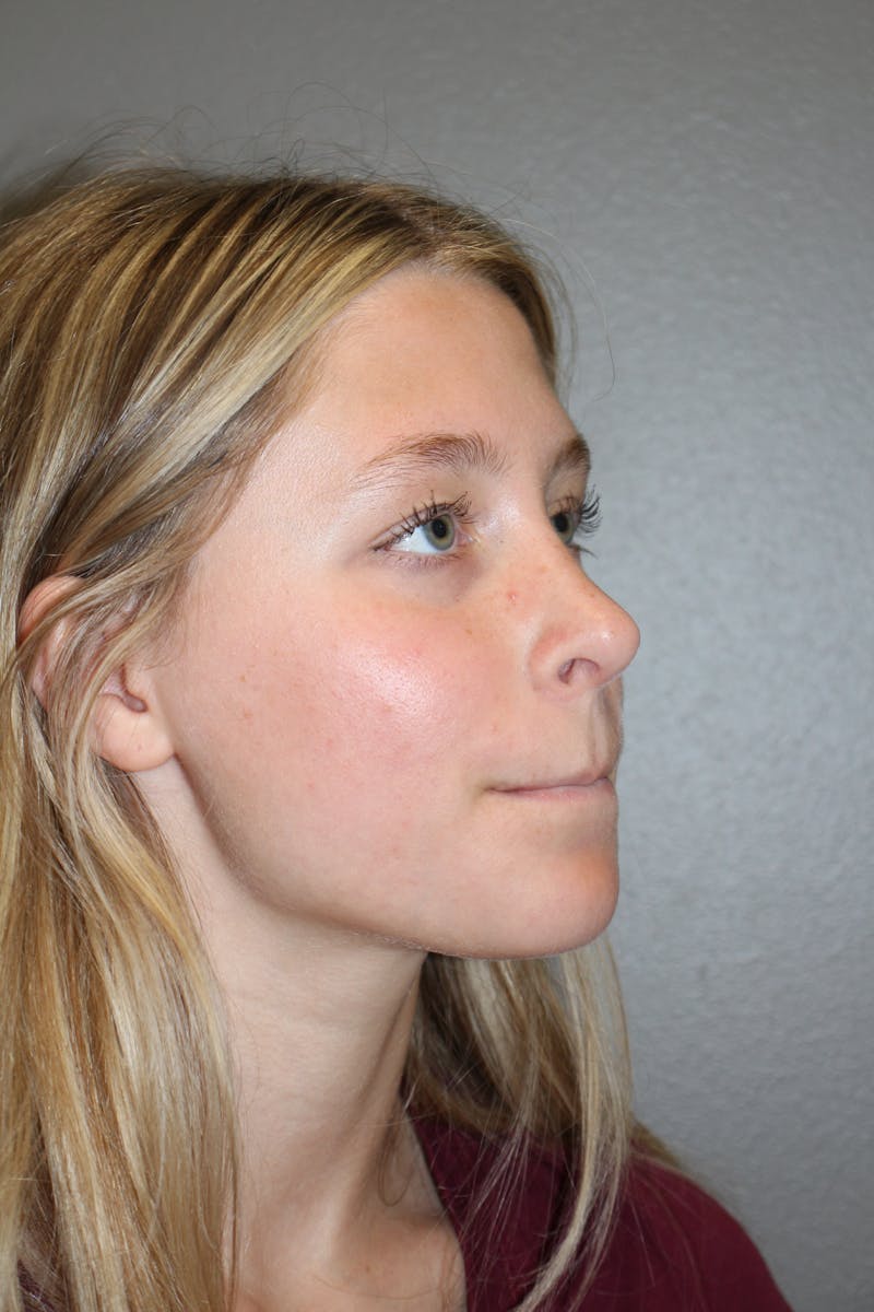 Rhinoplasty Before & After Gallery - Patient 415553 - Image 4