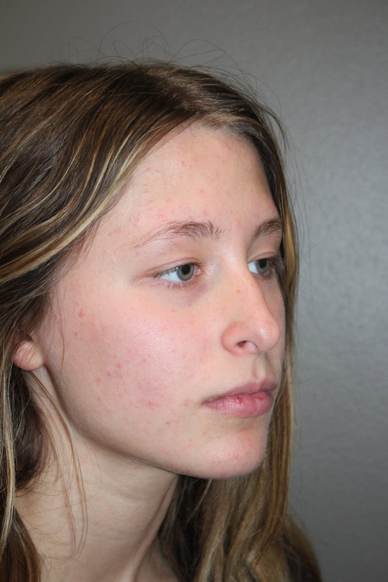 Rhinoplasty Before & After Gallery - Patient 415553 - Image 3