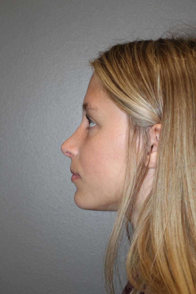 Rhinoplasty Before & After Gallery - Patient 415553 - Image 10