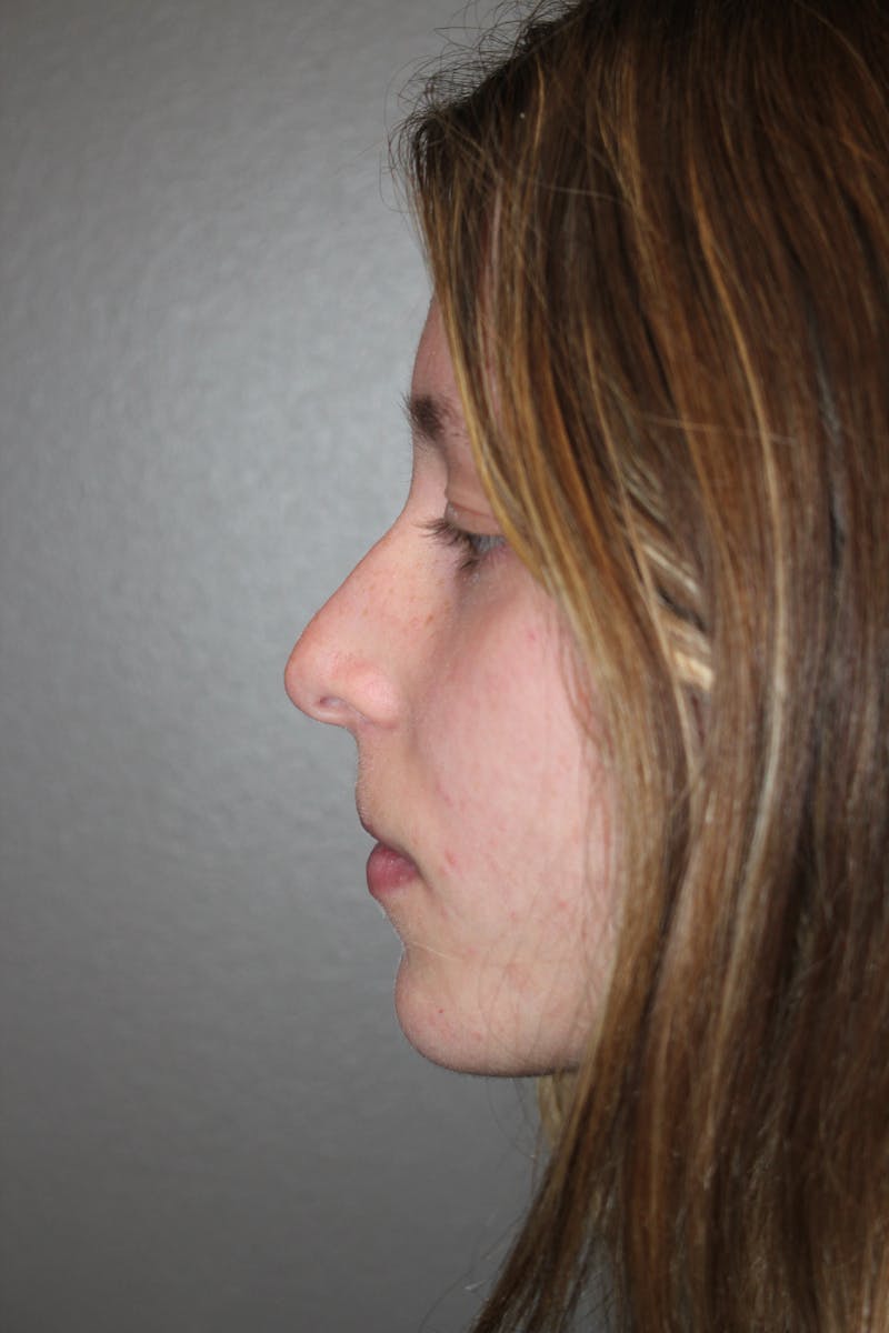 Rhinoplasty Before & After Gallery - Patient 415553 - Image 9