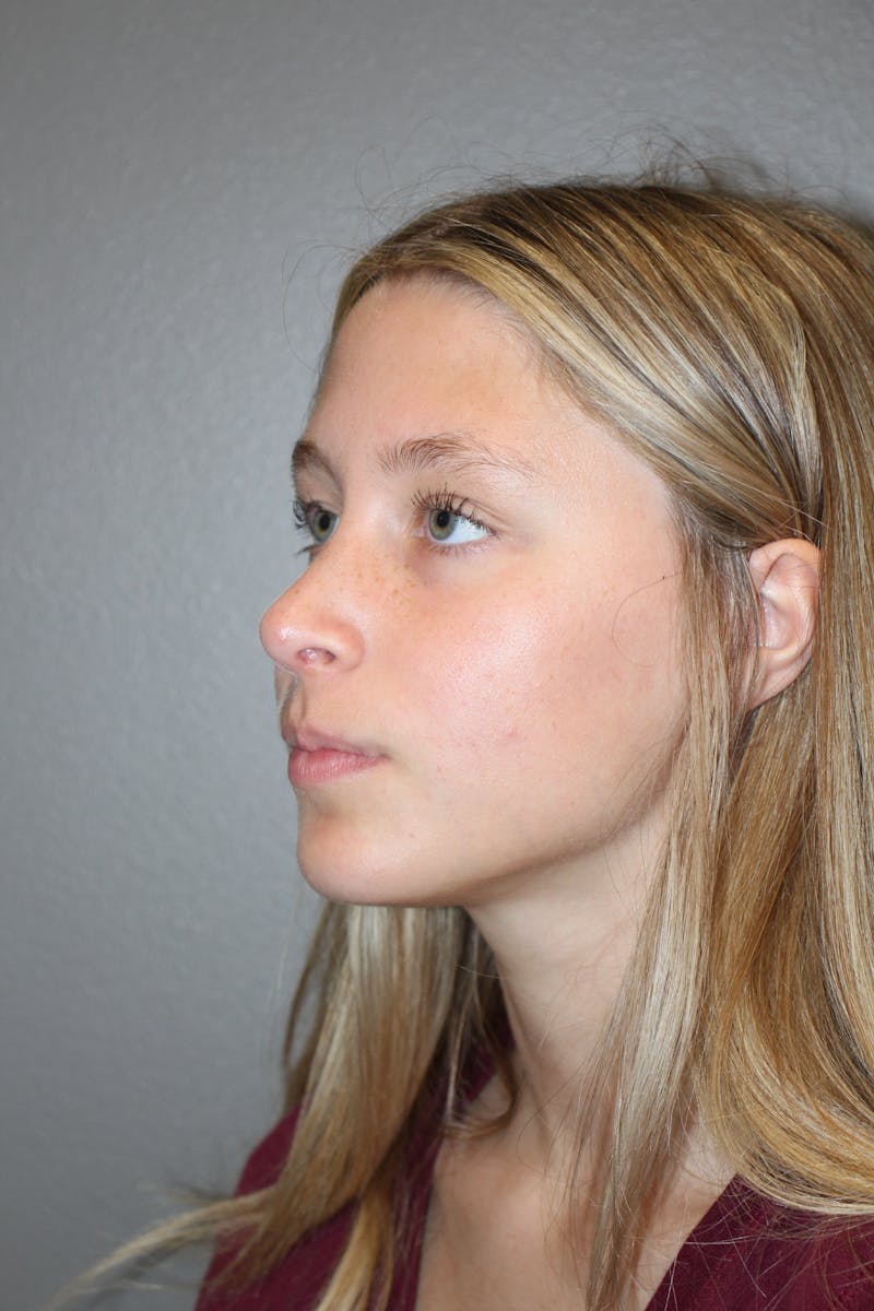 Rhinoplasty Before & After Gallery - Patient 415553 - Image 8