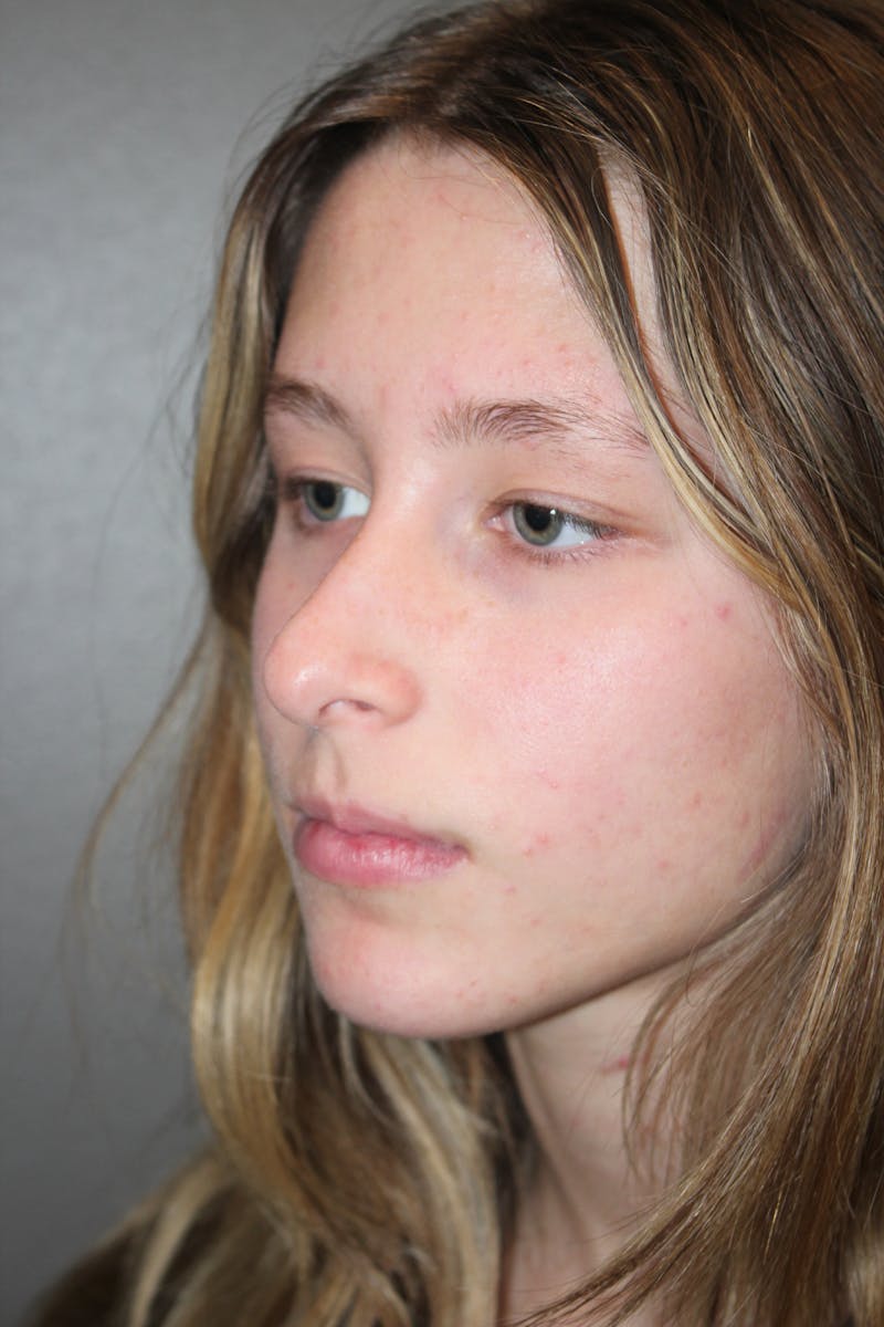 Rhinoplasty Before & After Gallery - Patient 415553 - Image 7