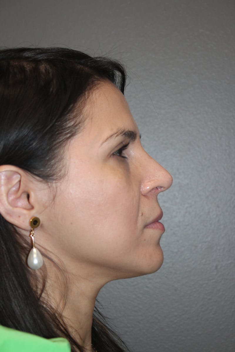 Rhinoplasty Before & After Gallery - Patient 415296 - Image 2