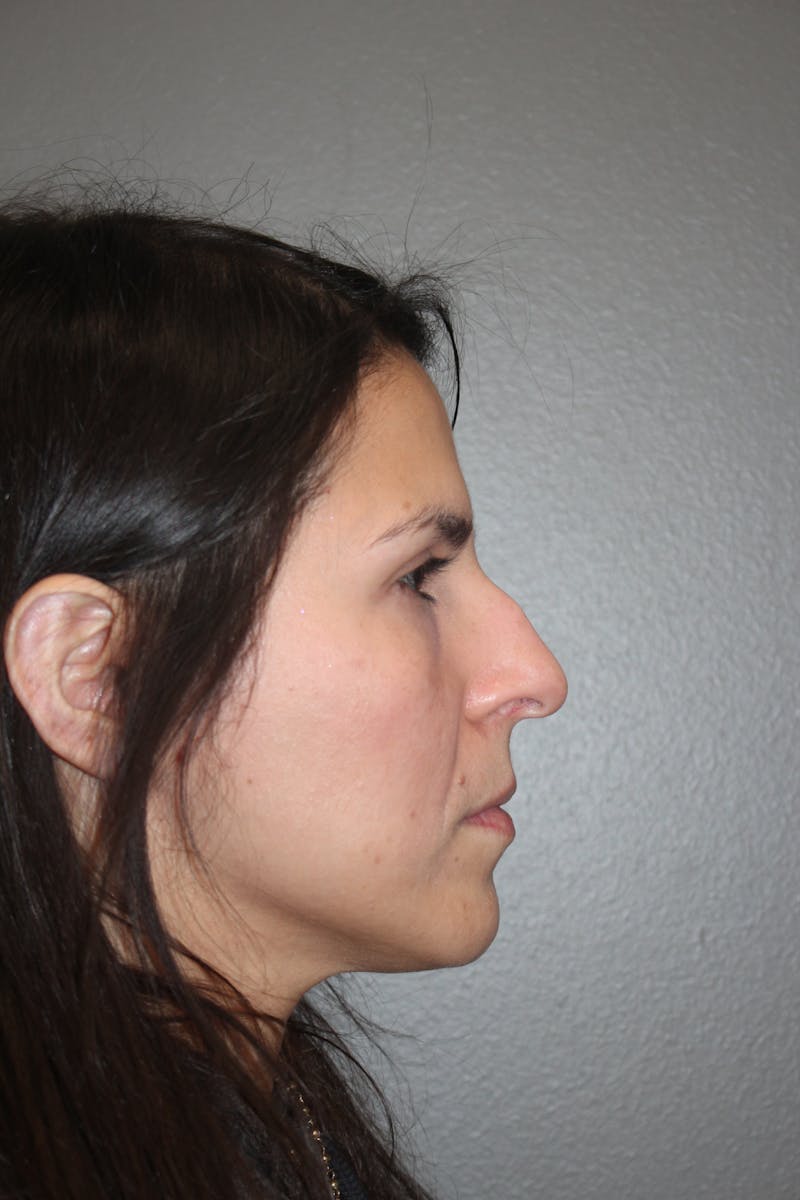 Rhinoplasty Before & After Gallery - Patient 415296 - Image 1