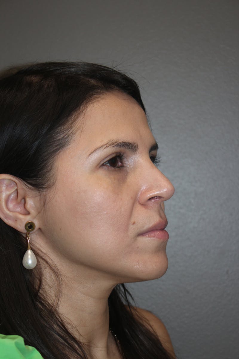 Rhinoplasty Before & After Gallery - Patient 415296 - Image 4
