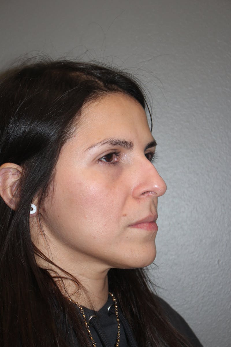 Rhinoplasty Before & After Gallery - Patient 415296 - Image 3