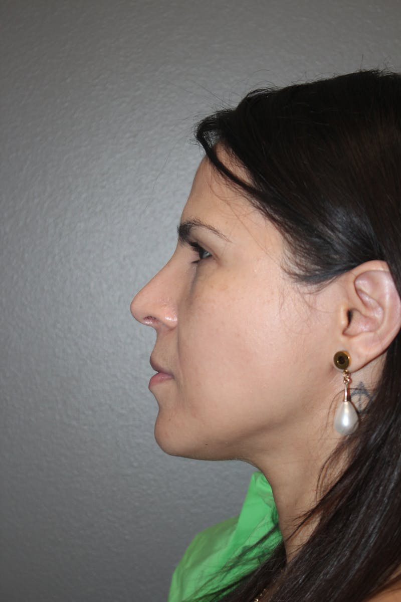Rhinoplasty Before & After Gallery - Patient 415296 - Image 10
