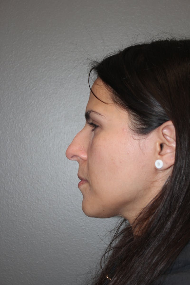 Rhinoplasty Before & After Gallery - Patient 415296 - Image 9