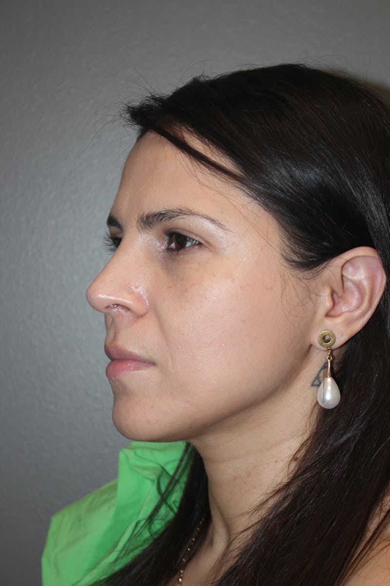 Rhinoplasty Before & After Gallery - Patient 415296 - Image 8