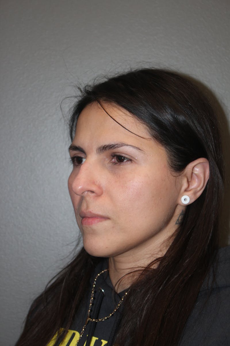 Rhinoplasty Before & After Gallery - Patient 415296 - Image 7