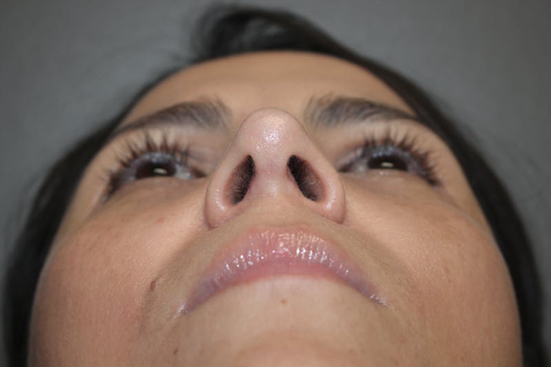 Rhinoplasty Before & After Gallery - Patient 415296 - Image 12
