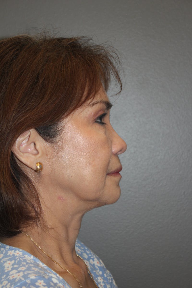Rhinoplasty Before & After Gallery - Patient 295276 - Image 2