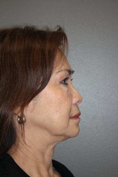 Rhinoplasty Before & After Gallery - Patient 295276 - Image 1