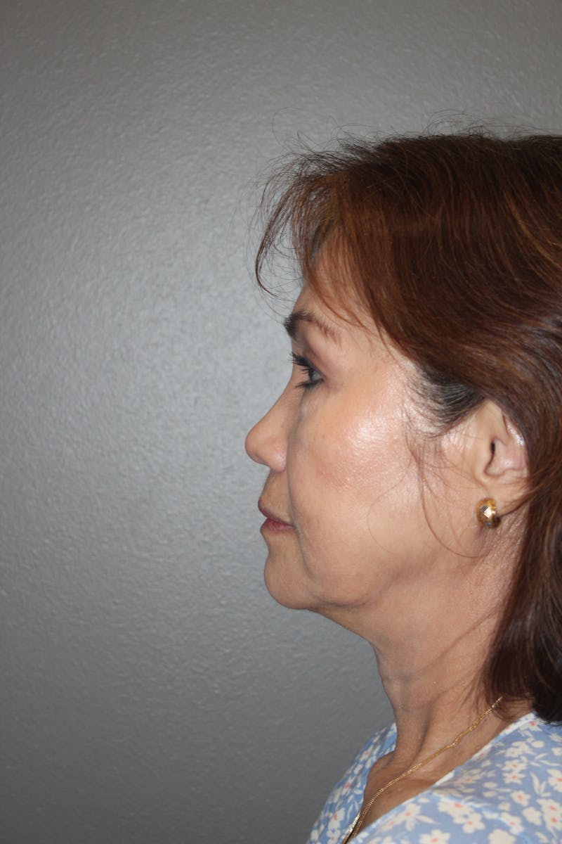Rhinoplasty Before & After Gallery - Patient 295276 - Image 10