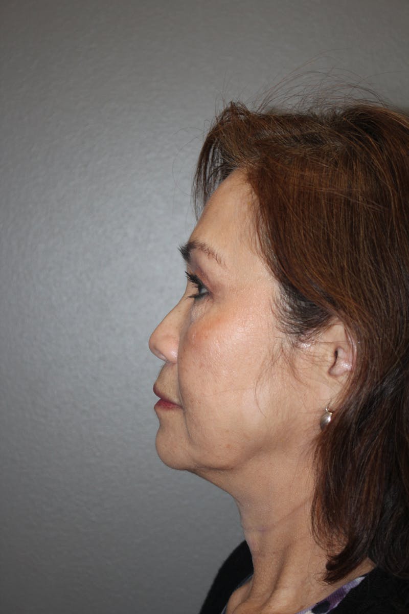 Rhinoplasty Before & After Gallery - Patient 295276 - Image 9