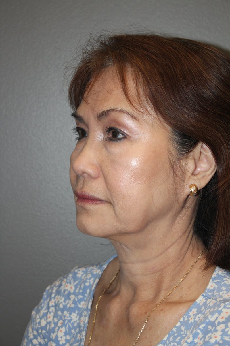 Rhinoplasty Before & After Gallery - Patient 295276 - Image 8
