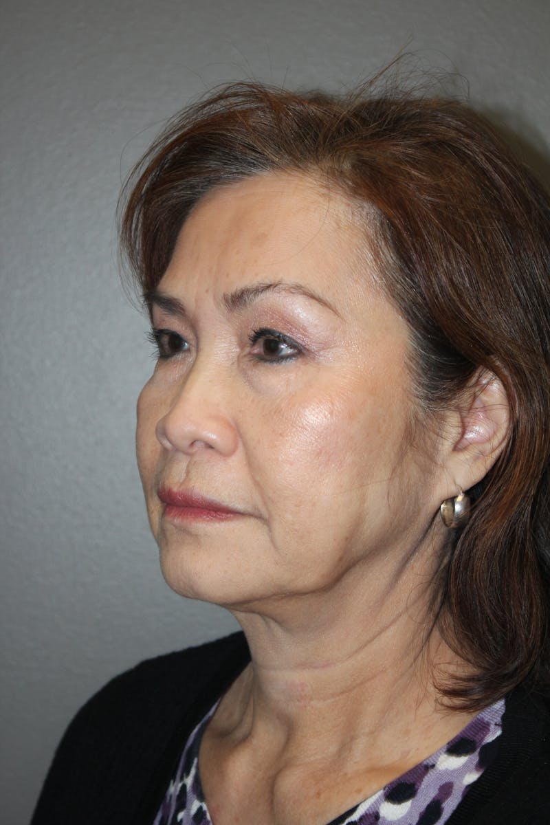 Rhinoplasty Before & After Gallery - Patient 295276 - Image 7