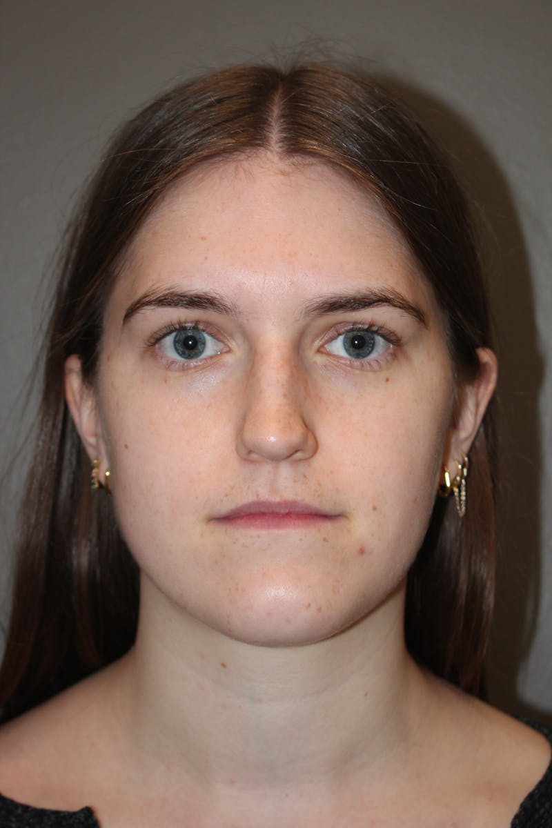 Rhinoplasty Before & After Gallery - Patient 192728 - Image 5
