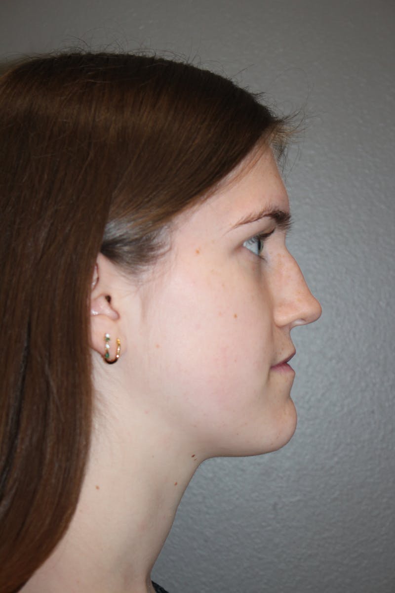Rhinoplasty Before & After Gallery - Patient 192728 - Image 1