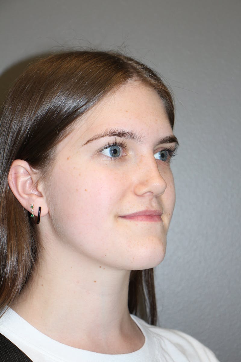 Rhinoplasty Before & After Gallery - Patient 192728 - Image 4