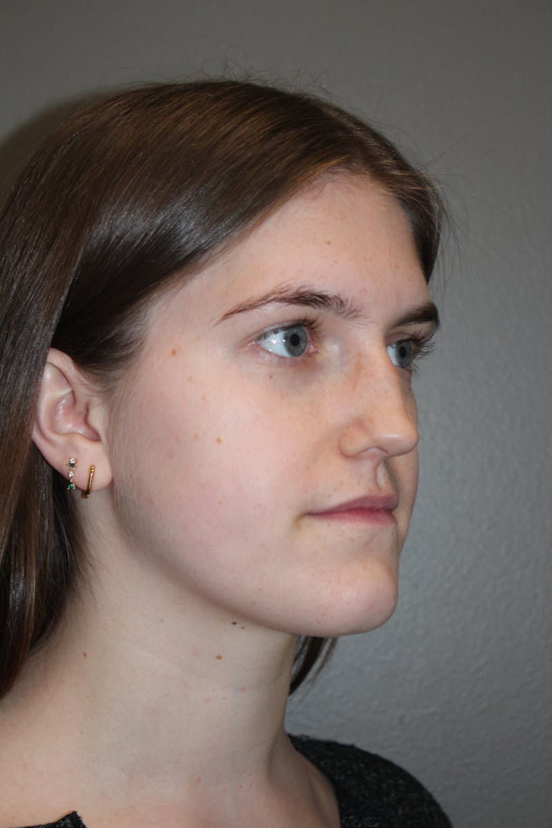 Rhinoplasty Before & After Gallery - Patient 192728 - Image 3