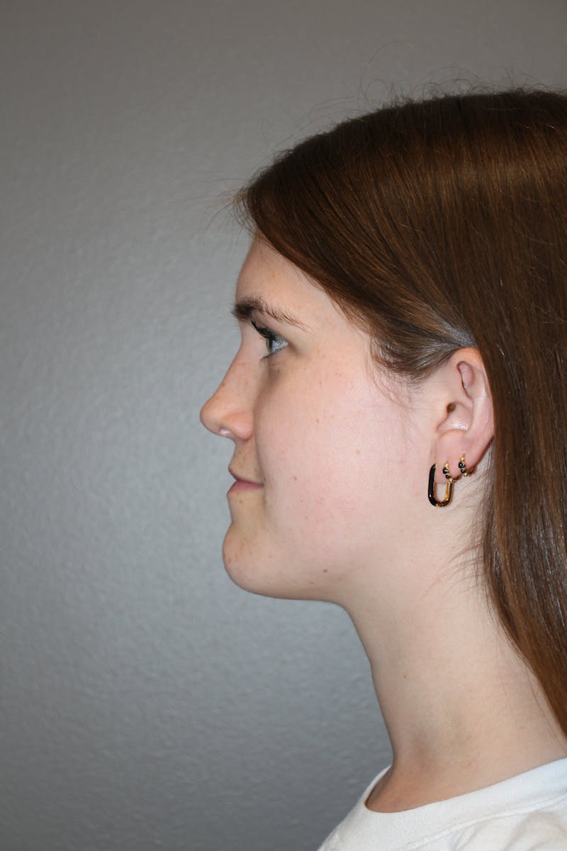 Rhinoplasty Before & After Gallery - Patient 192728 - Image 10