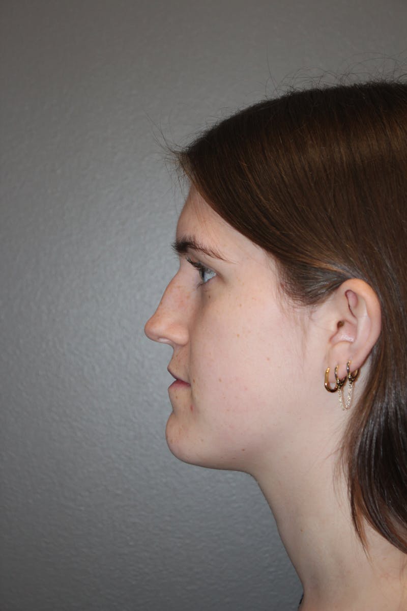 Rhinoplasty Before & After Gallery - Patient 192728 - Image 9
