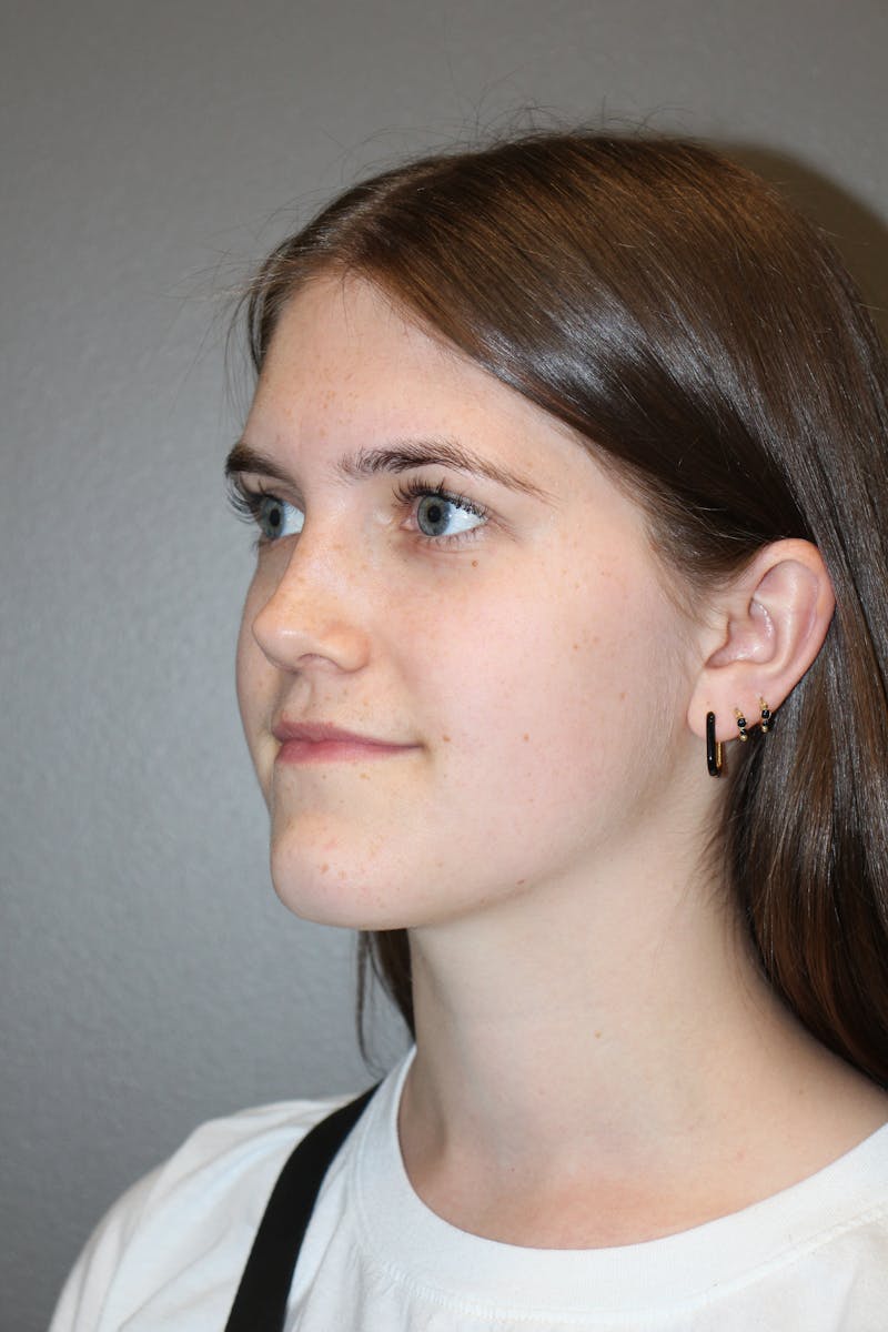 Rhinoplasty Before & After Gallery - Patient 192728 - Image 8