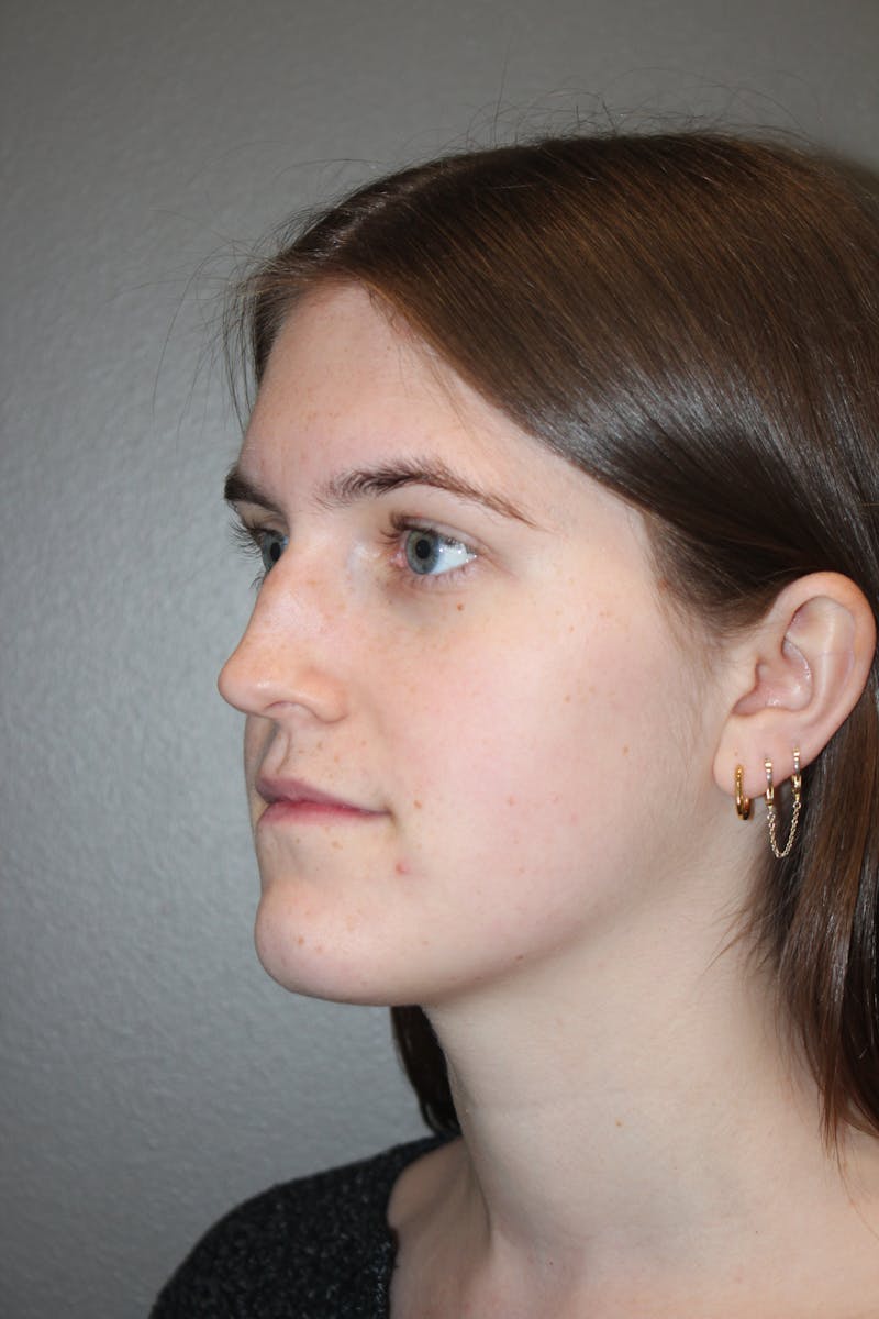 Rhinoplasty Before & After Gallery - Patient 192728 - Image 7