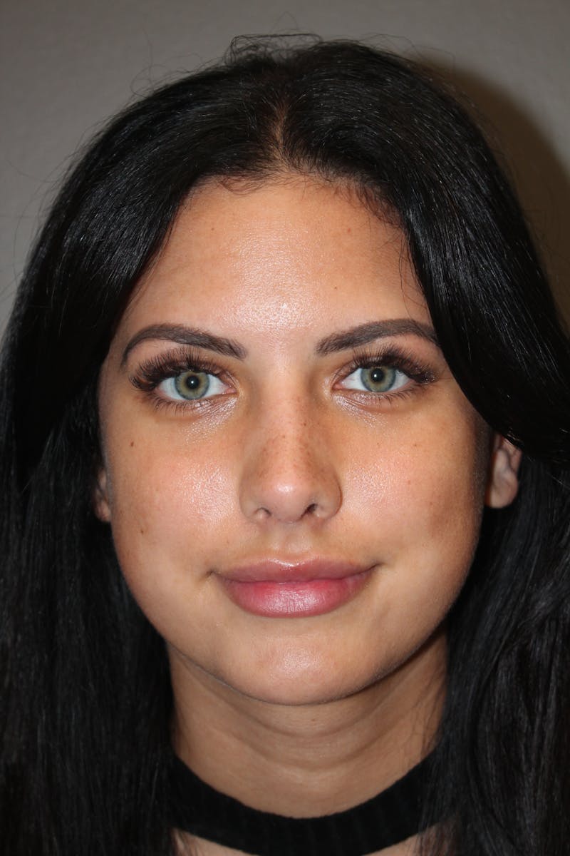 Rhinoplasty Before & After Gallery - Patient 173758 - Image 6